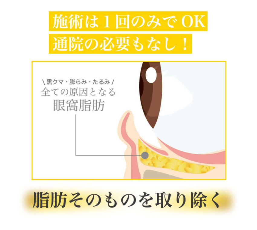 黒クマ・ふくらみ・たるみ、全ての原因となる眼窩脂肪そのものを取り除くので施術は1回でOK