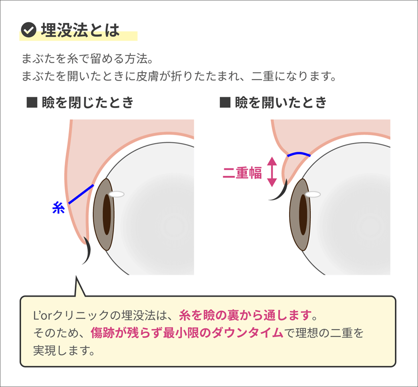 埋没法手術とは