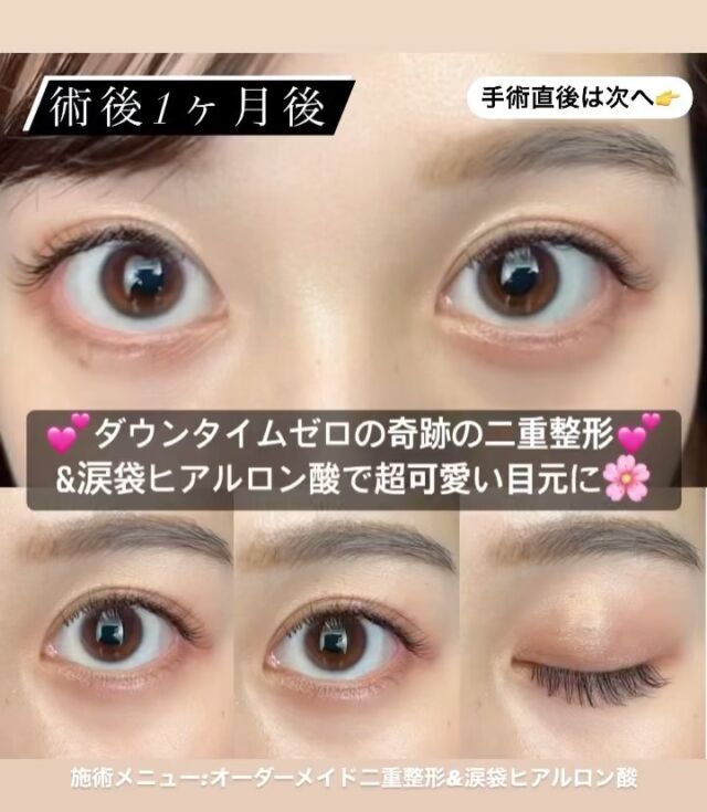 二重 目元 L Or Clinic Omotesando 二重 目元 L Or Clinic Omotesando